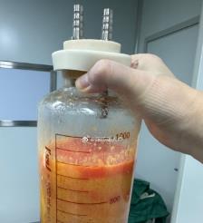 赵县水动力吸脂手术要做多久？